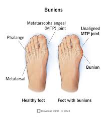 How the Serene Toe Aligner™ Can Transform Your Foot Health